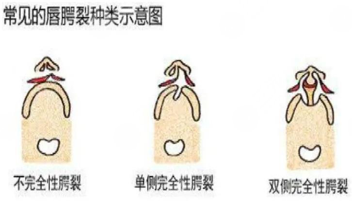 唇腭裂手術(shù)