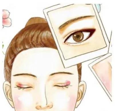 吳焱秋雙眼皮案例