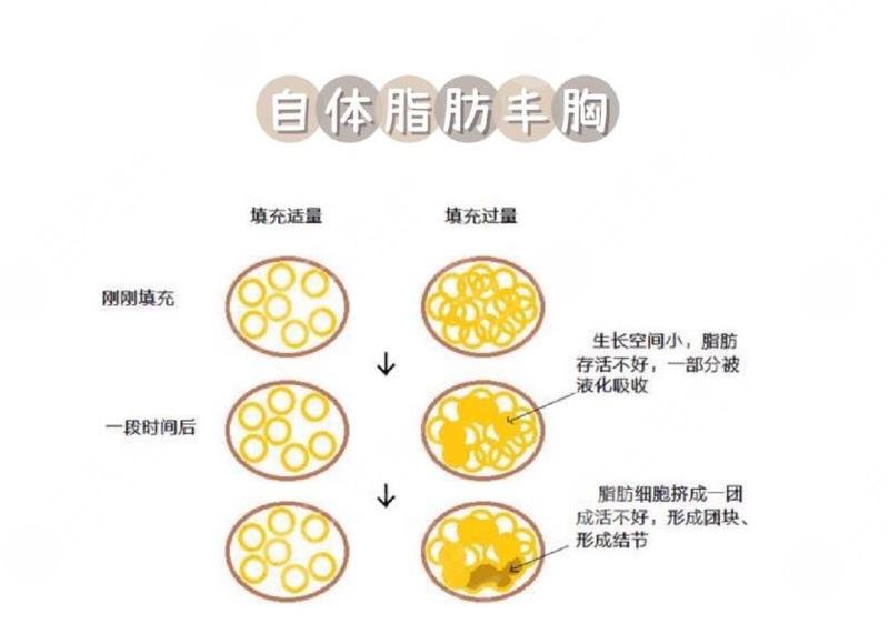脂肪豐胸可以維持多長(zhǎng)時(shí)間