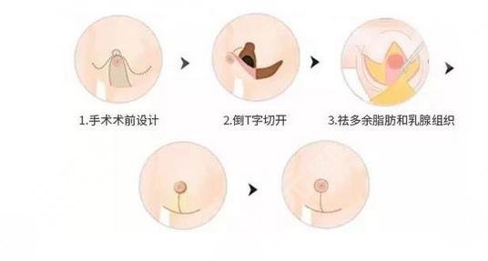 縮胸手術(shù)風(fēng)險(xiǎn)大嗎?會(huì)危及生命嗎?