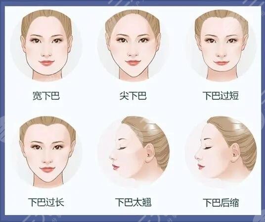 深圳填充下巴多少錢？玻尿酸2800元起，輪廓塑形指南！
