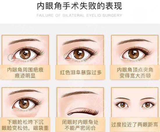 合肥李小靜眼角回包修復(fù)案例分享！安醫(yī)熱門整形醫(yī)生，等你品評~