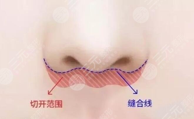 人中縮短