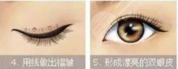雙眼皮