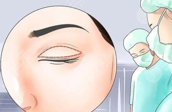 腫眼泡