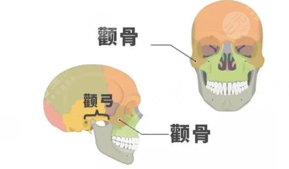 顴骨高