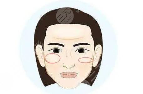 顴骨高