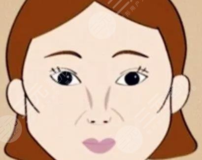 顴骨高