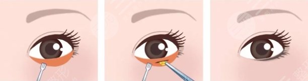 眶隔釋放