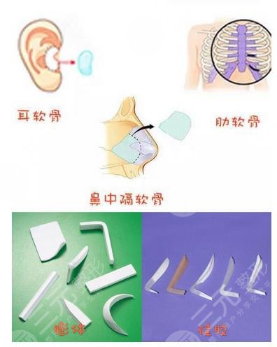 李健醫(yī)生鼻整形案例