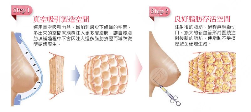 隆胸