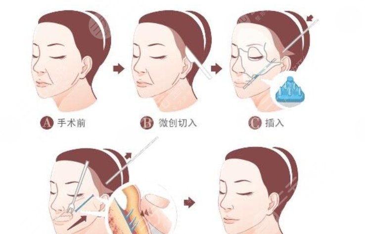懸吊技術(shù)