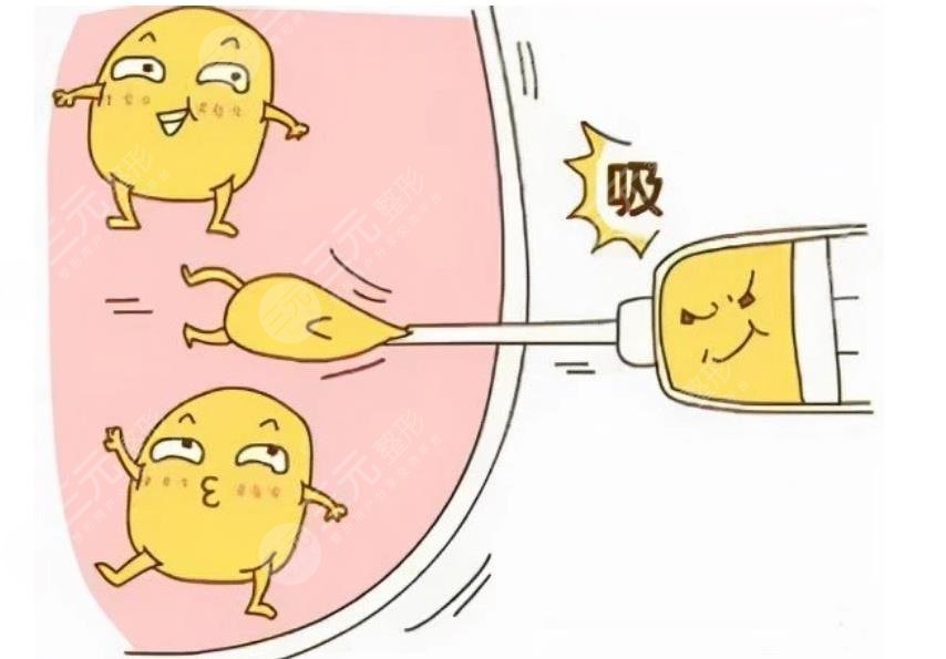 王仁根醫(yī)生吸脂案例