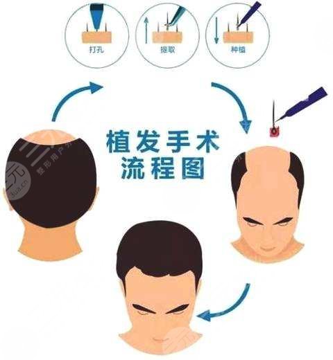 6000元植發(fā)面積是多少
