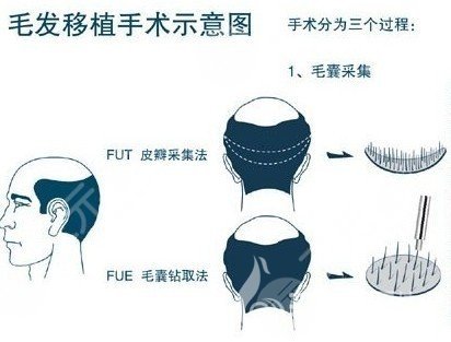 6000元植發(fā)面積是多少