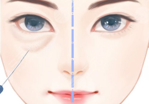 李聰麗醫(yī)生雙眼皮怎么樣