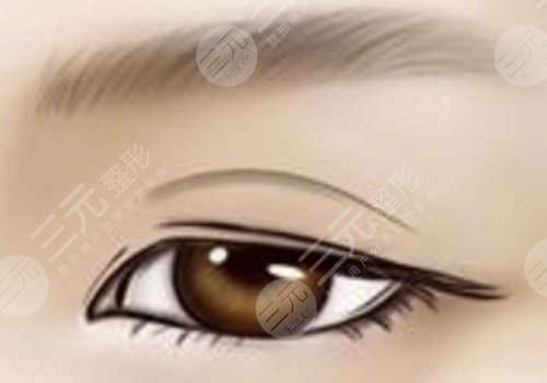 范希玲修復(fù)雙眼皮案例