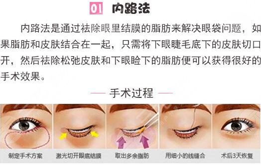 大連于芷晗去眼袋多少錢？2300元起，醫(yī)生技術(shù)特點(diǎn)&案例為你匯總！