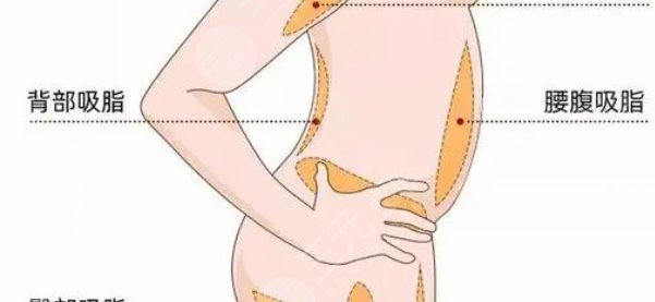 360度環(huán)形吸脂腹部