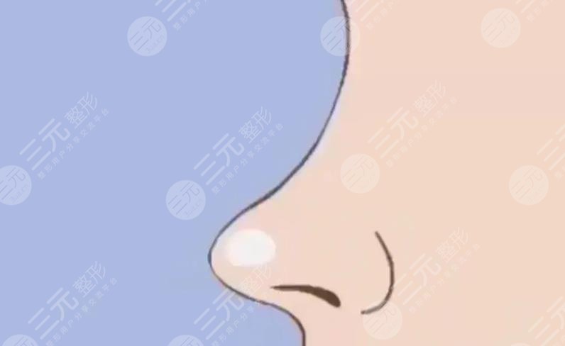 鼻修復