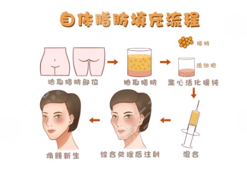 汕頭市中心醫(yī)院整形脂肪填充多少錢