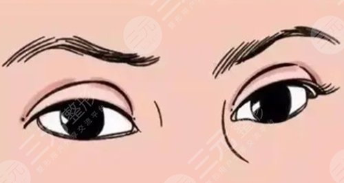 雙眼皮