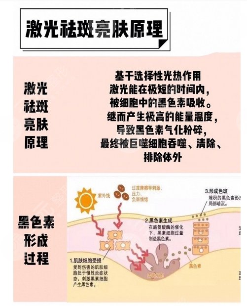 激光祛斑