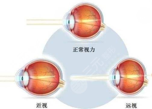 近視眼