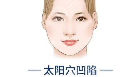 自體脂肪填充