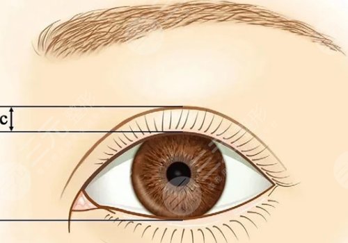 紀(jì)影暢雙眼皮