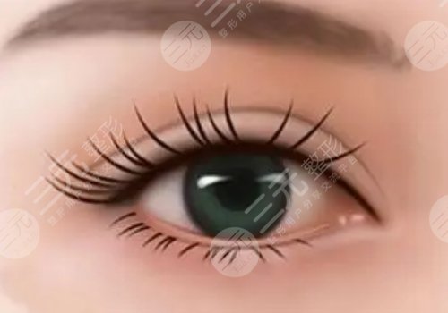 紀影暢雙眼皮案例