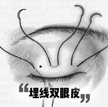 雙眼皮