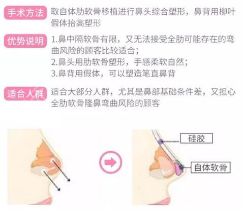 肋骨鼻