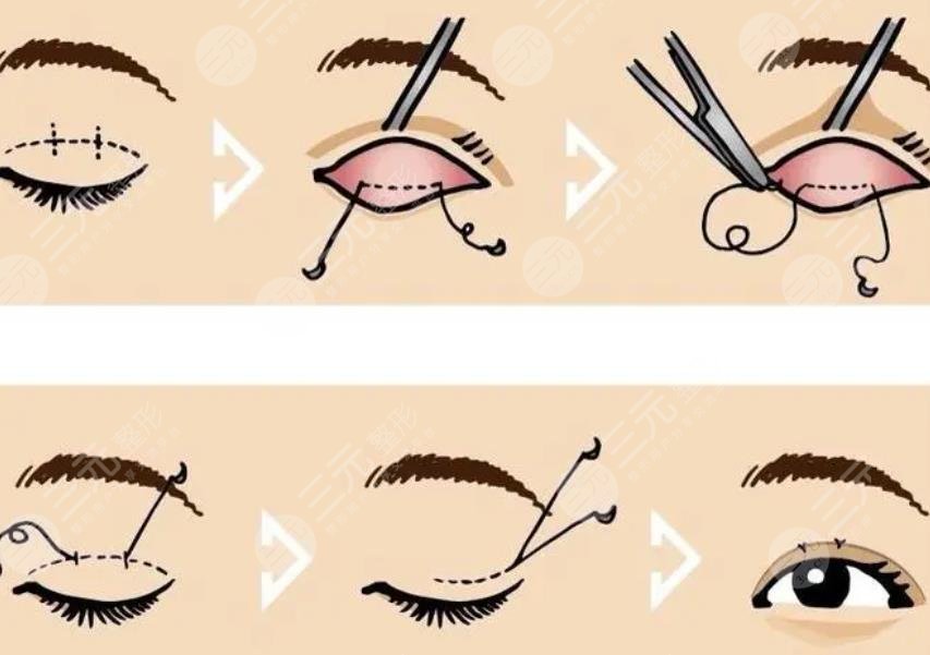  全切雙眼皮1個月恢復圖