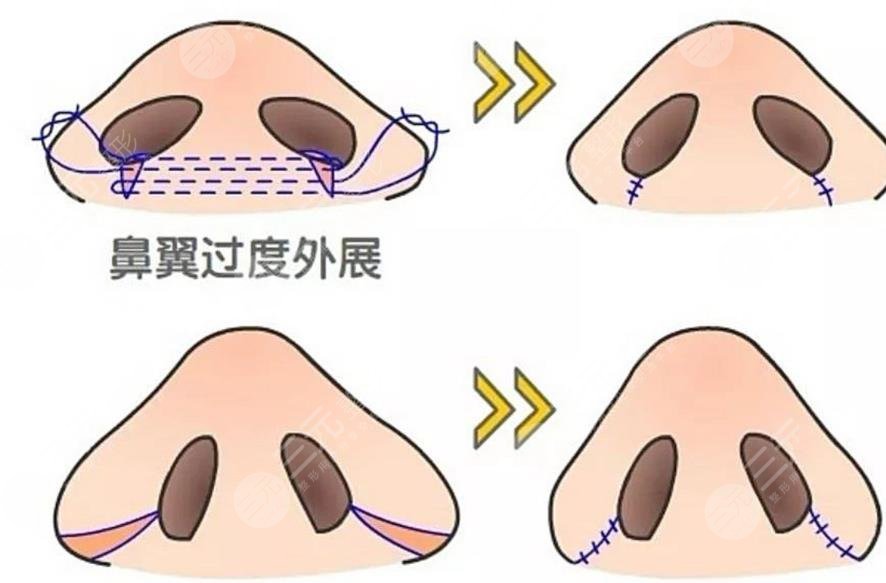 鼻翼縮小