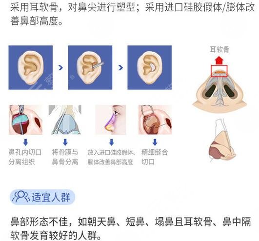 隆鼻