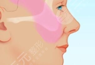 拉皮