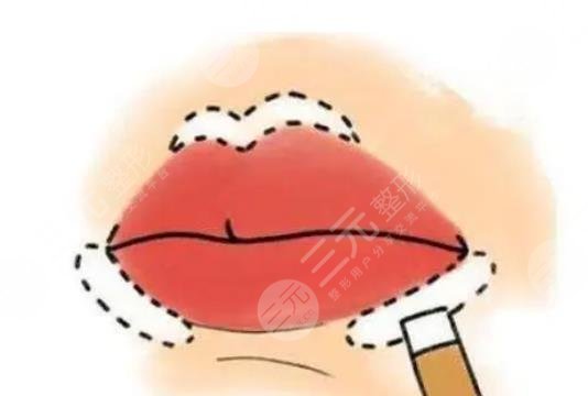 玻尿酸豐唇