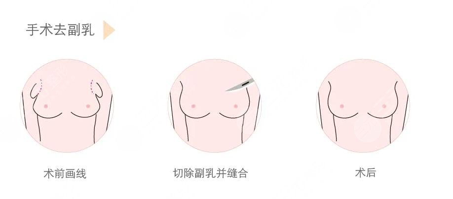 上海九院縮乳手術(shù)費(fèi)用是多少?