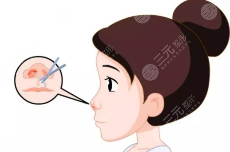 鼻尖整形