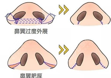 鼻修復(fù)