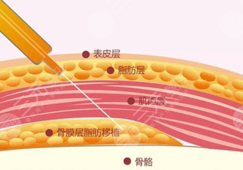 脂肪填充能維持幾年