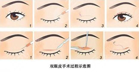 上海九院王俊芳雙眼皮口碑怎么樣