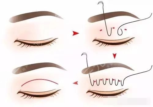 上海九院王俊芳雙眼皮口碑怎么樣