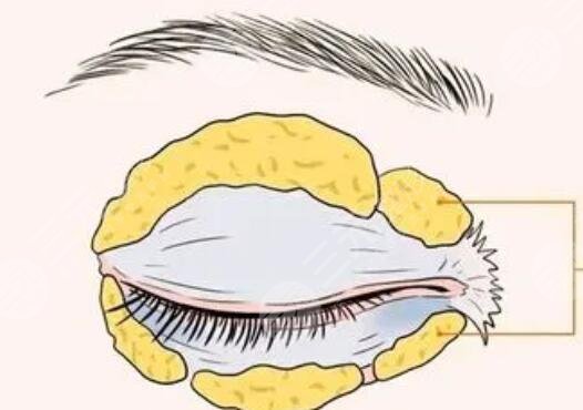 雙眼皮