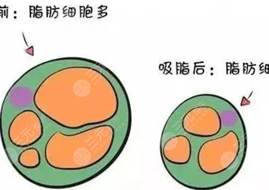 吸脂