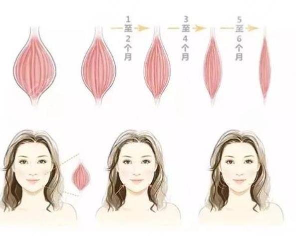 注射瘦臉