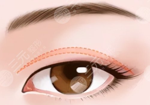 姜留剛雙眼皮案例怎么樣的