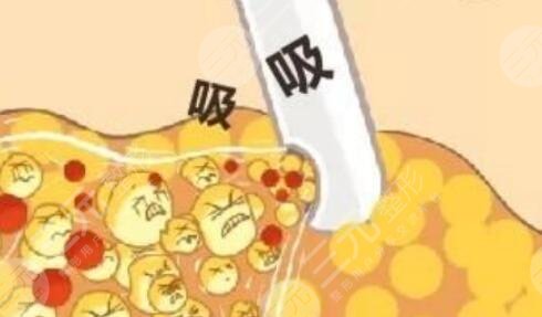 吸脂