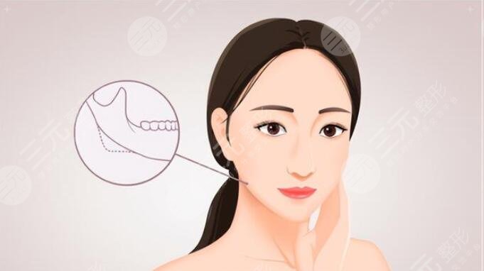 廣州沈紹勇醫(yī)生下頜角整形案例